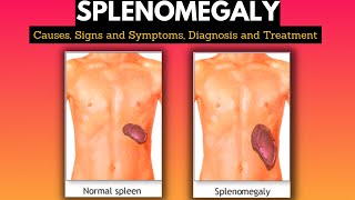 Splenomegaly Causes Signs and Symptoms Diagnosis and Treatment [upl. by Sinnej]