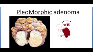 Pathology 533 a Pleomorphic Adenoma Mixed Salivary Tumor Gland Parotid Benign Lacrimal [upl. by Ez]