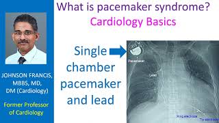 What is pacemaker syndrome Cardiology Basics [upl. by Joacimah458]