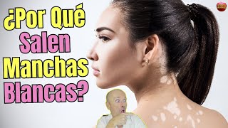 🆘 ¿PORQUE SALEN MANCHAS BLANCAS EN LA PIEL 🆘 [upl. by Barry]