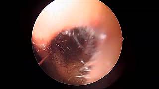 Unedited part 3 endoscopic septal correction spurectomy [upl. by Phia]