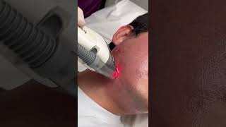 Dr Molinari  Traitement acné 2ème partie  laser Fraxel [upl. by Amabelle]