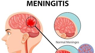 Meningitis  Part 1  Pathology  Harsh Mohan  Notes  Easy Explanation [upl. by Ecilayram]