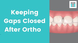 KEEPING YOUR GAPS CLOSED AFTER ORTHO l Dr Bailey Orthodontist [upl. by Adnofal]