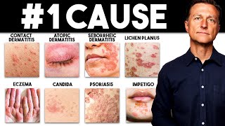 The MOST Common Deficiency in All Skin Diseases Dermatitis [upl. by Eldreda]