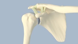 Acromioclavicular Separation Surgery [upl. by Eohce]