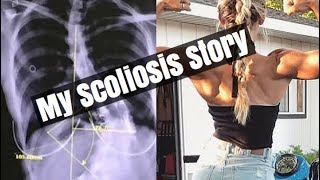 My Scoliosis Story [upl. by Karina]