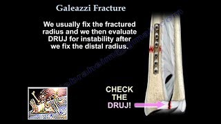 Galeazzi Fracture  Everything You Need To Know  Dr Nabil Ebraheim [upl. by Sophronia557]