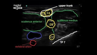 Prefixed brachial plexus sonographic appearance [upl. by Herve805]