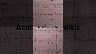 Acute Pericarditis ECG Widespread STsegment elevation [upl. by Odlaumor]