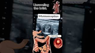 Intussusception A Review of real time ultrasound case Presentation DrSaima khan shorts [upl. by Karyn]