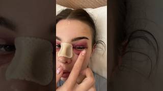 NOSE JOB VLOG  DAY 1 😳 [upl. by Norah]