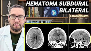 HEMATOMA SUBDURAL BILATERAL [upl. by Dorkas]