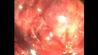 Endoscopy Master Videos ERCP metal stent in a metal stent  wwwgastrolivercomsg [upl. by Neelloj]