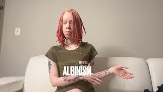 What is Albinism My experience tips amp advice [upl. by Nnylyar]