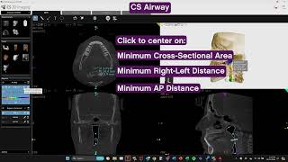 CS Airway Quick Demo [upl. by Stubbs358]