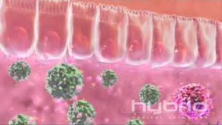 Pathology of Crohns disease [upl. by Clayborn251]