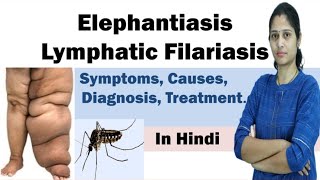 Elephantiasis  Filariasis  Symptoms Causes Diagnosis Treatment Prevention  In Hindi [upl. by Pelligrini]