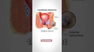 Hemorrhoids What is the Cause [upl. by Nywg130]