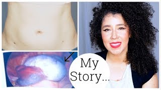 Im Back  My Ovarian Cyst Story  Ovarian Torsion  Laparoscopy Surgery [upl. by Anwahsiek565]