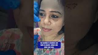 UnderEye Filler Treatment  Skin Clinic  Skin Treatment  Kolkata  youtubereels youtubeshorts [upl. by Cyrie85]