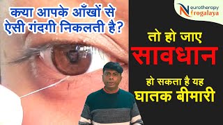 Are You Facing This EyeIssue  Successful Treatment Without Surgery  Neurotherapy Treatment [upl. by Ahseeyt]