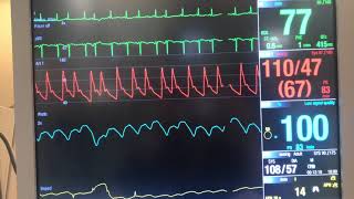 Arterial Line Waveform in Atrial Fibrillation [upl. by Anaz]