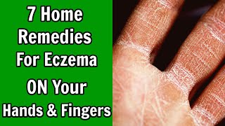 7 Home Remedies For Eczema on Hands And Fingers [upl. by Amyas]