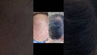 Over 11K Grafts Norwood 6 Hair Transplant Dr Felipe Pittella hairtransplant [upl. by Hunt]