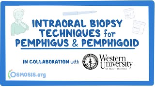 Intraoral Biopsy Techniques for Pemphigus amp Pemphigoid in Collaboration w Western University [upl. by Nahtannoj989]