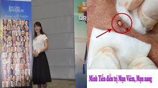 Acne treatment reputation effective at Hien Van Spa376Minh Tienpart 1 [upl. by Dlarej]