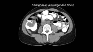Dr Osterwalder CT Befunde bei Dickdarmkrebs 2014 [upl. by Byran]