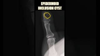 Epidermoid Inclusion Cyst bones radiology doctor [upl. by Eita855]