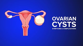 Signs and Symptoms of Ovarian Cysts [upl. by Immat276]