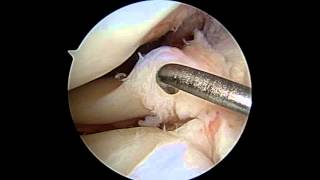 Lateral Meniscus Repair [upl. by Ruhnke837]