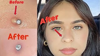 How to get rid of a nose piercing bump fast Keloid [upl. by Anelra]