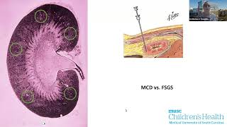 Pediatric FSGS and the Utility of Lipopheresis CME Recording [upl. by Azerila124]