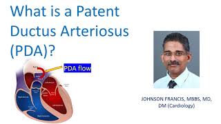 What is a Patent Ductus Arteriosus PDA [upl. by Ettenom653]