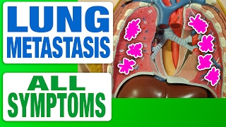 Lung Metastasis  All Symptoms [upl. by Helas]