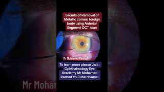 Secrets of Removed of Metallic corneal foreign body using Anterior Segment OCT جسم غريب علي القرنية [upl. by Odette]