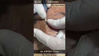 Subcision Treatment for Acne scars by Dr Vijay Kumar at AWISH CLINIC acnescars subcision shorts [upl. by Millwater]