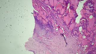 Goiter  Histopathology slides [upl. by Aicssej]