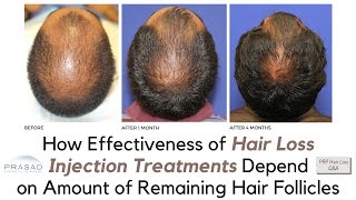 Why PRP and PRP ACell Treatments for Hair Loss Need Viable Hair Follicles to Work [upl. by Nohsav]