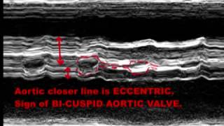 BICUSPID AORTIC VALVE  ECHOCARDIOGRAPHY SERIES BY DR ANKUR K CHAUDHARI [upl. by Yeltnarb50]