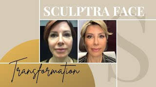 Sculptra Before amp After  My Review on the NonSurgical Facelift  Dominique Sachse [upl. by Amairam]