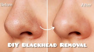 ✨ DIY Blackhead Removal ✨ Get Clear Skin at Home [upl. by Crary757]