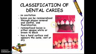 Lecture Day 3 Review of Cariology [upl. by Eldin]
