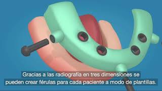 Cirugía guiada Implantes Dentales  Clínica Dental MiBO Almería [upl. by Sirovart319]