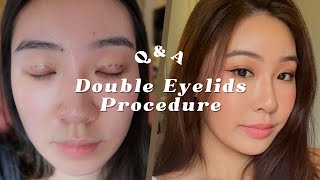 Nonincisional Double eye lids surgery 8 months Postrecovery QampA ft Allure Plastic Surgery [upl. by Ahsoyek929]