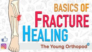 Fracture Healing  ANIMATION  BASICS  The Young Orthopod [upl. by Euqinomod]